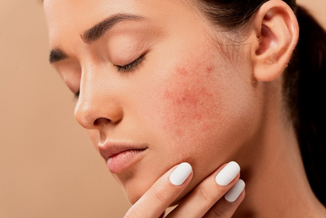 Comment éviter l’acné ?